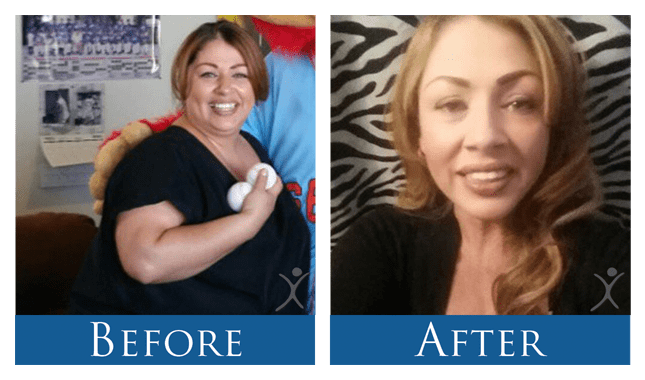 Dr. Ismael Cabrera - Gastric Sleeve Surgery Patient Before and After Picture