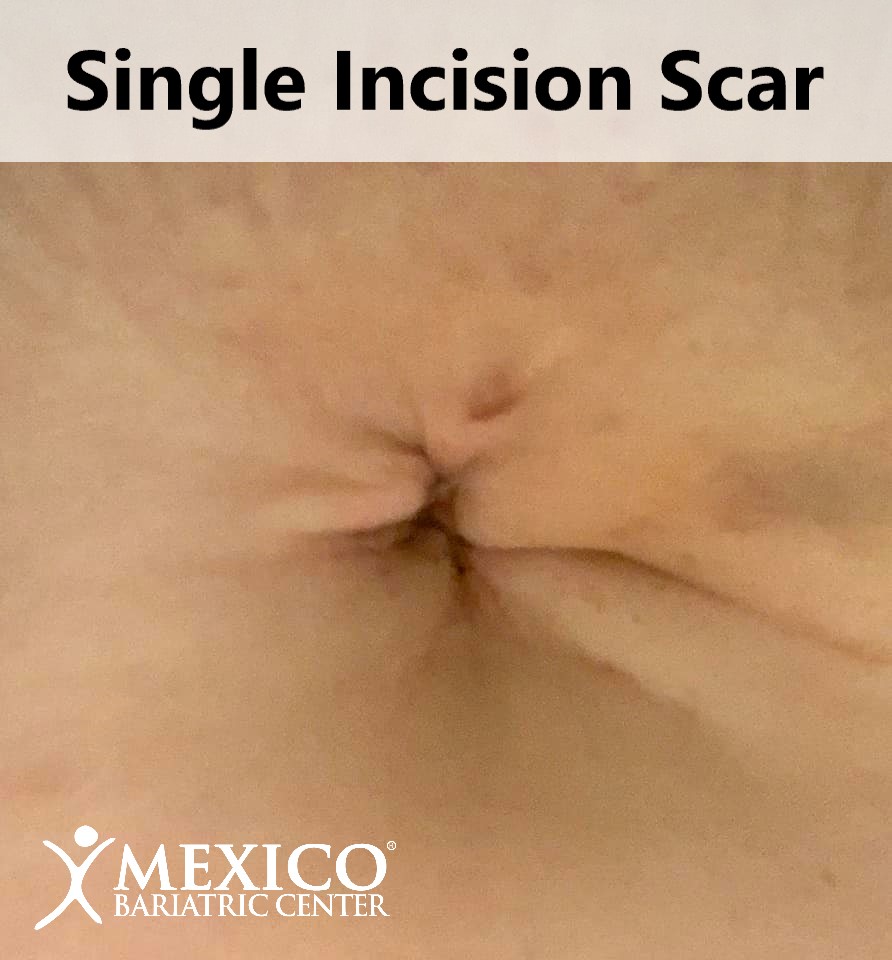 single incision gastric sleeve scar